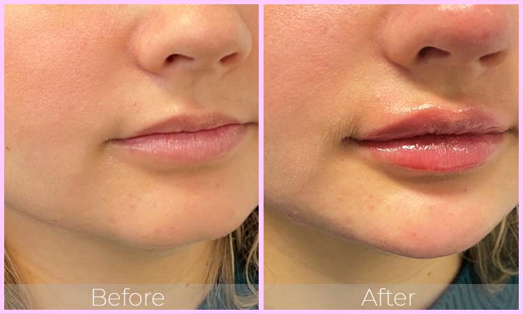 Lower Face Filler Sydney Canberra Queen Of The Skin