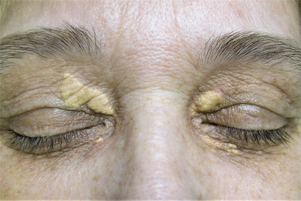 Laser Xanthelasma Removal Queen Of The Skin