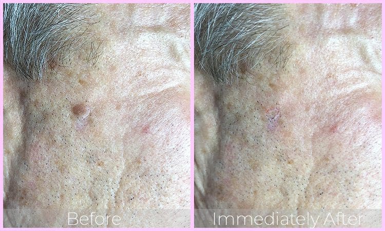 Laser Seborrheic Keratosis Removal Sydney & Canberra - Queen of The Skin